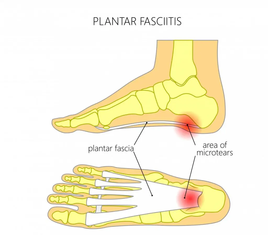 infrared light therapy for plantar fasciitis