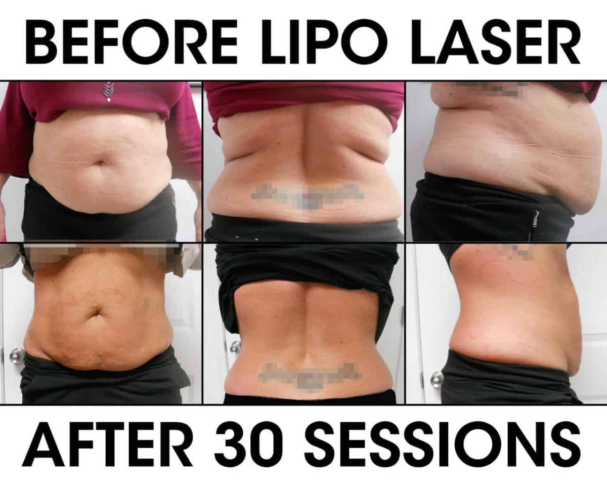 How Often Can You Do Laser Lipo? Infrared for Health